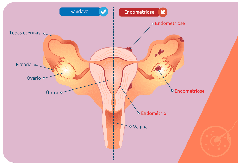 Musculação para mulheres com Adenomiose e Endometriose em Brasília: como o acompanhamento do Personal Igor Kenol transforma resultados em saúde real A dor crônica não precisa ser seu estado natural. Para muitas mulheres que convivem com Adenomiose ou Endometriose, cada dia pode parecer uma disputa constante com desconfortos, limitações e um corpo que parece não cooperar. Mas existe um ponto de virada que a Ciência vem reforçando: a musculação bem orientada melhora — e muito — qualidade de vida, energia, mobilidade e até sintomas inflamatórios. É exatamente aqui que entra o trabalho do Personal Trainer Igor Kenol, especialista em treinamento funcional e musculação para mulheres, com atendimento presencial em Brasília e Taguatinga, além de consultoria online em todo o Brasil.
